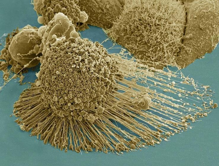 Thwarting Metastasis by Breaking Cancer’s Legs with Gold Rods